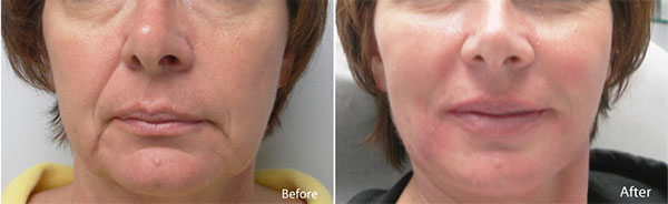 Dermal Fillers