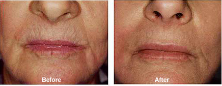 Dermapen Micro-Needling Skin Treatment