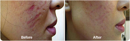 Dermapen for scars before & after