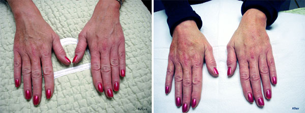 Hand Rejuvenation Treatment with Radiesse