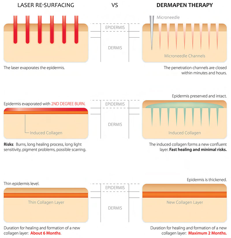 Laser Therapy VS Dermapen for Collagen Induction