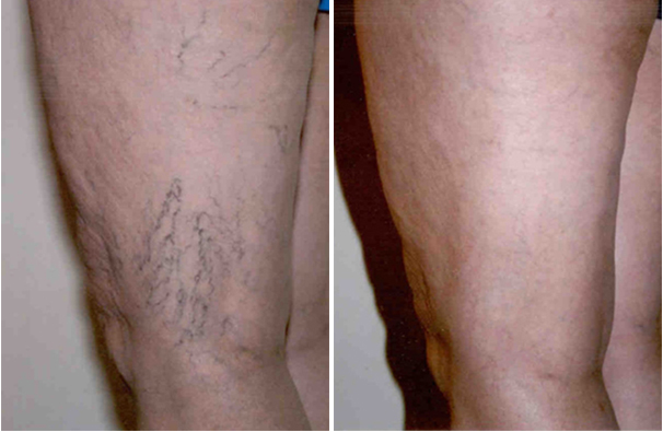 Sclerotherapy for Spider Veins