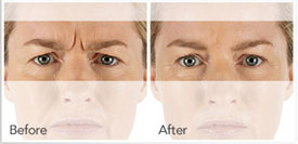 Xeomin Treatment for frown lines