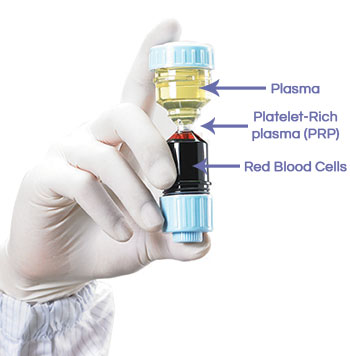 Platelet-Rich Plasma Treatment