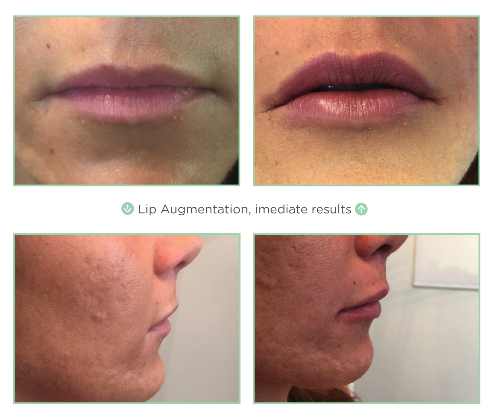 Before & After NovaThread Lips