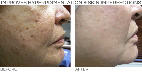 PRP Improves Hyperpigmentation